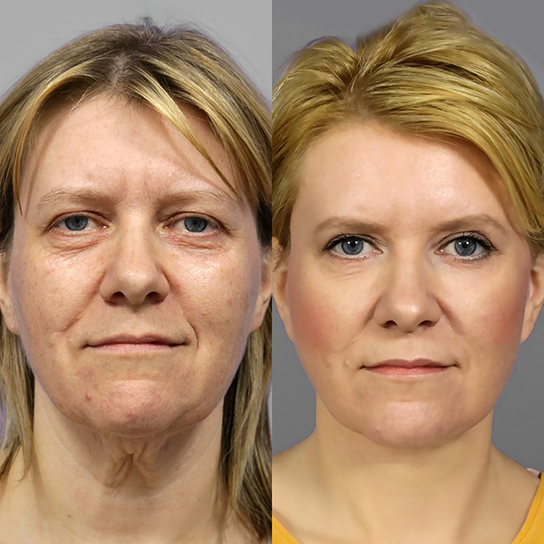 Neck Lift