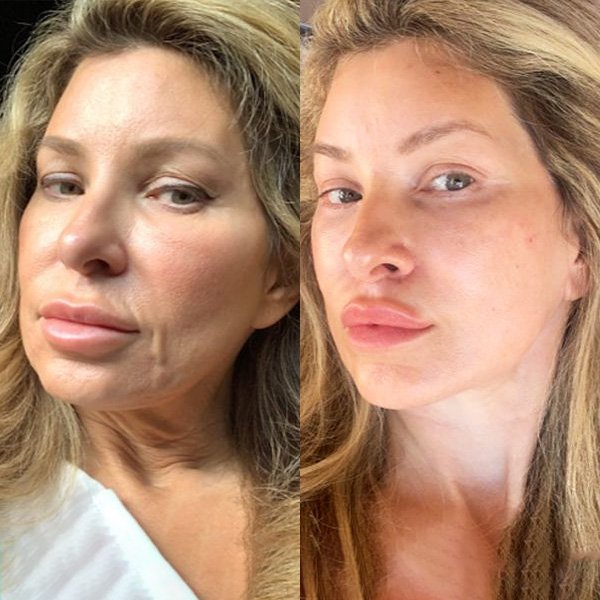 Neck Lift