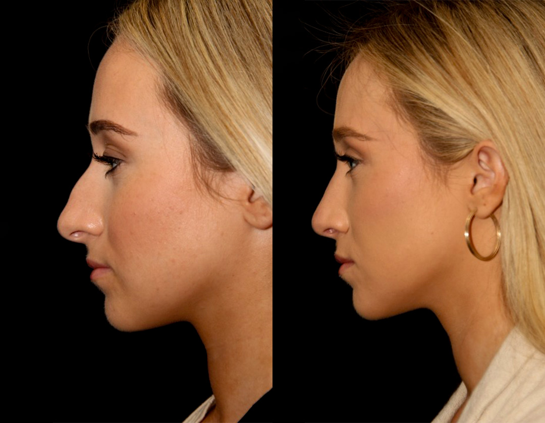 Rhinoplasty