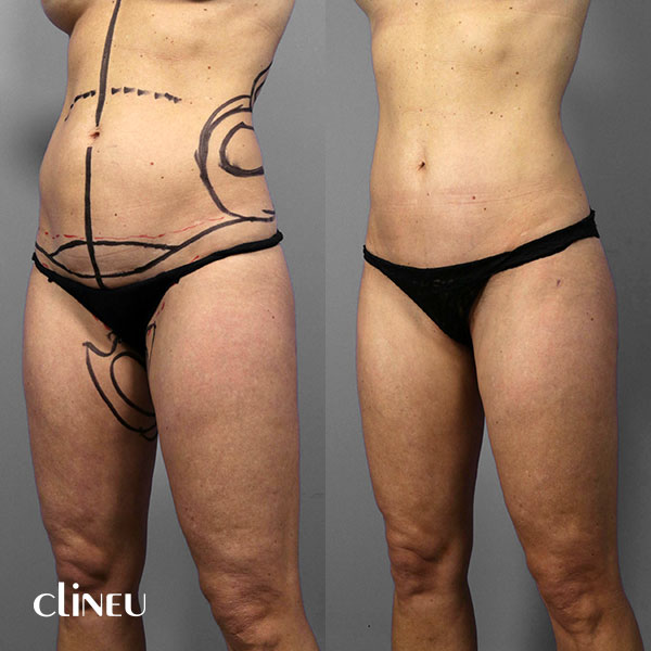 abdominoplasty