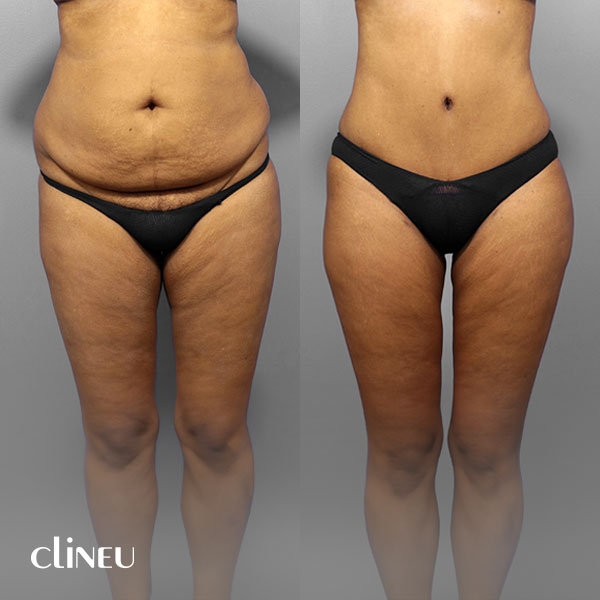 abdominoplasty