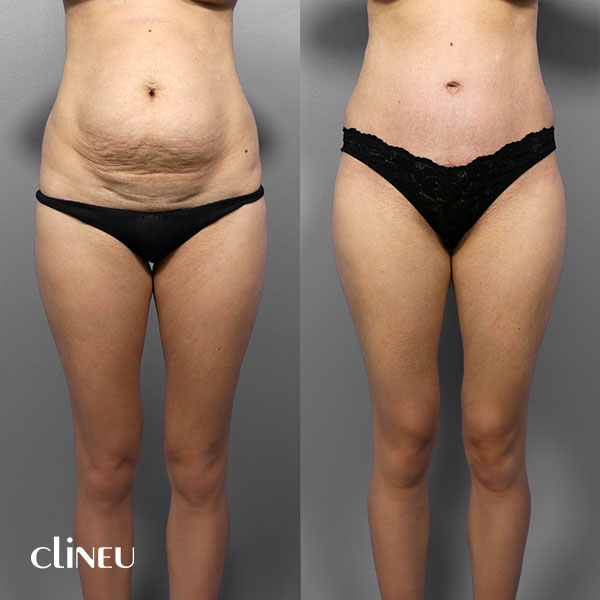 abdominoplasty