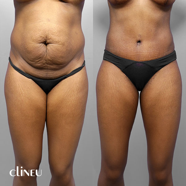 abdominoplasty