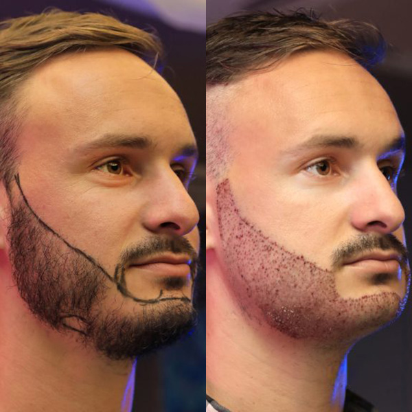 beard transplant