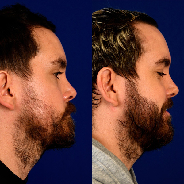 Beard Transplant