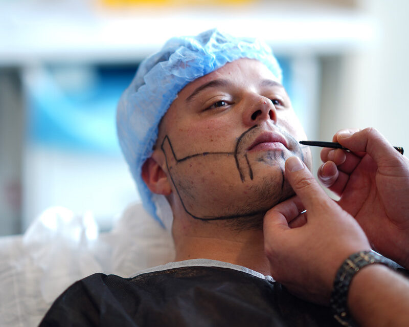 beard transplant cost