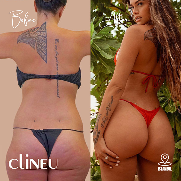 Brazilian Butt Lift