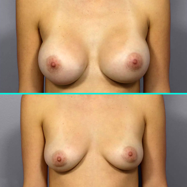 Breast Implant Removal