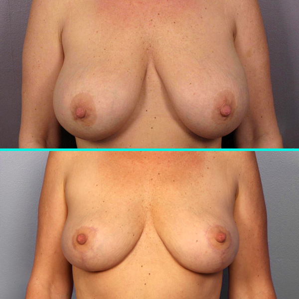 Breast Implant Removal