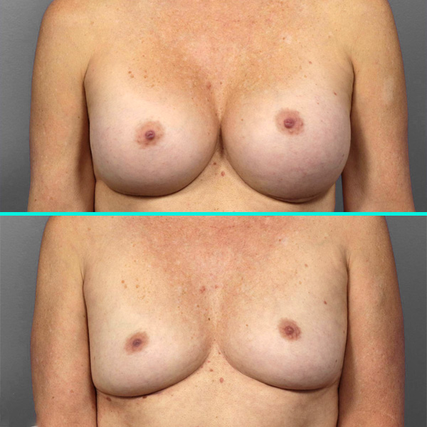 Breast Implant Removal