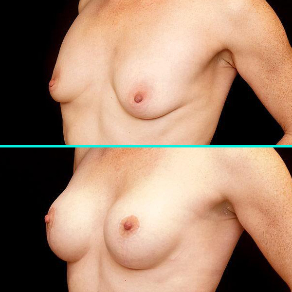 Breast Lift