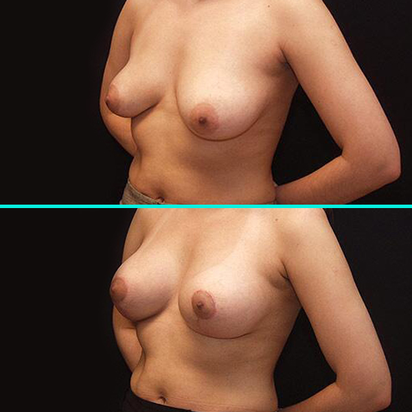 Breast Lift