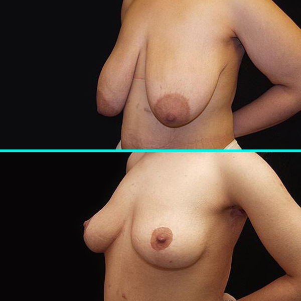 Breast Lift