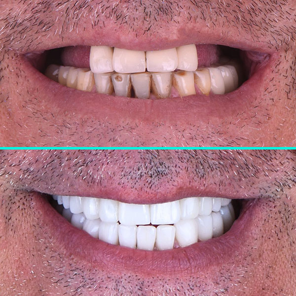 Dental Implants