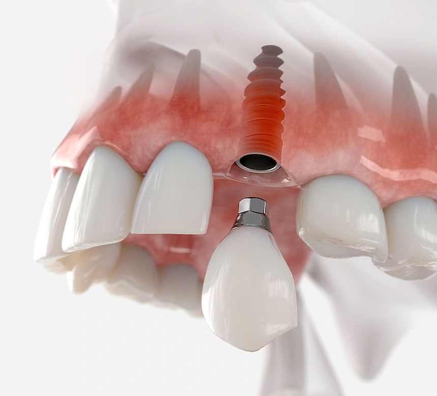 Dental Implants Cost