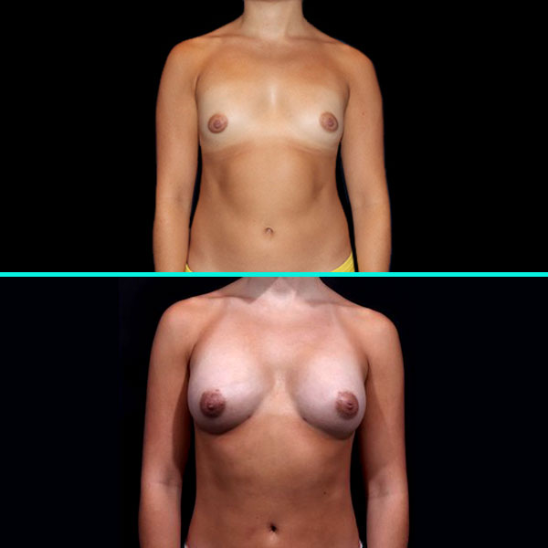 Fat Transfer Breast Augmentation