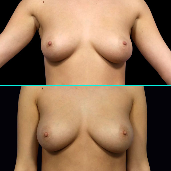 Fat Transfer Breast Augmentation