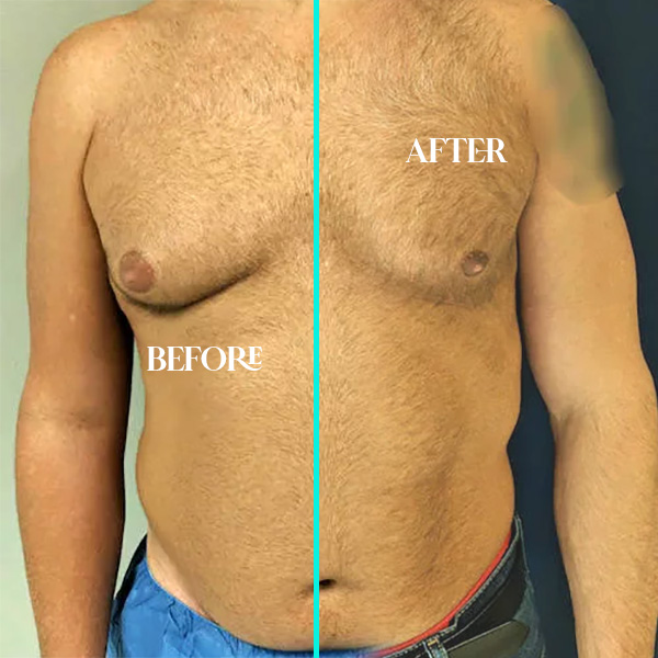 gynecomastia