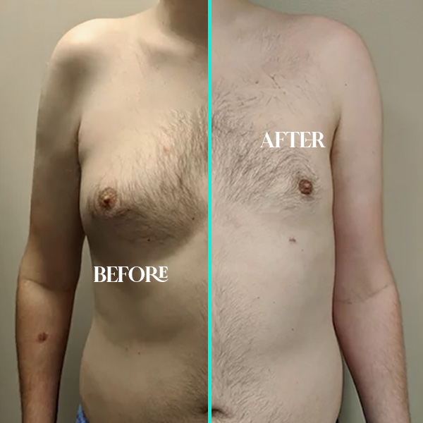 gynecomastia