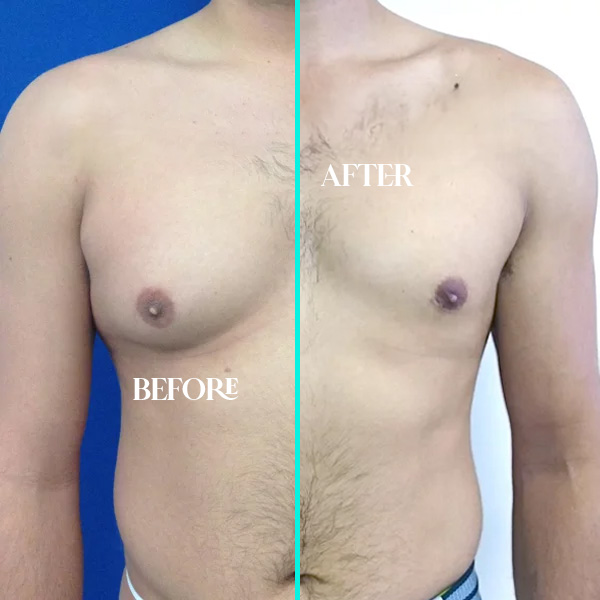 gynecomastia