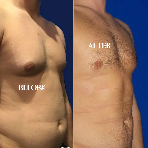 gynecomastia