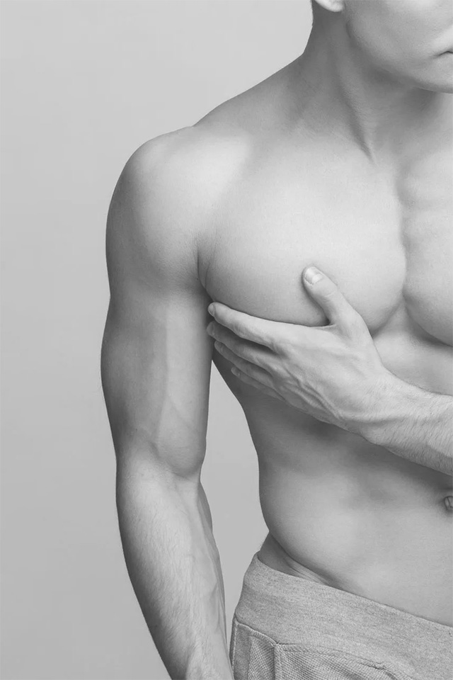 gynecomastia