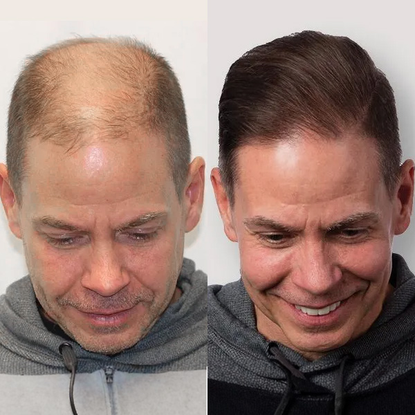 Hair Transplant