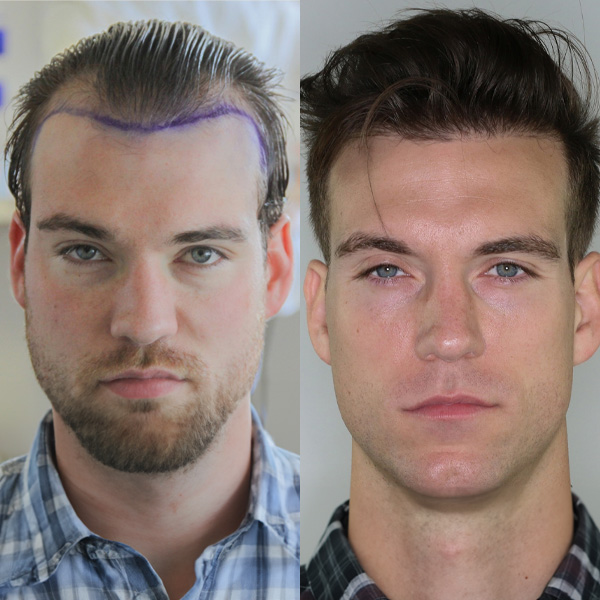 Hair Transplant