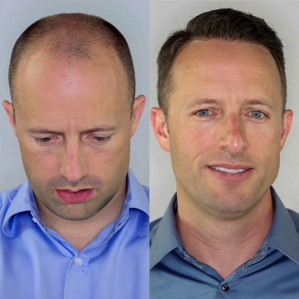 Hair Transplant