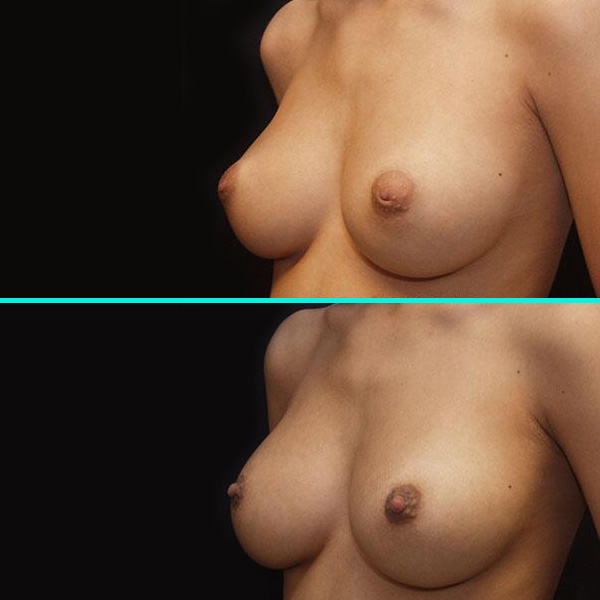 Inverted Nipple Surgery