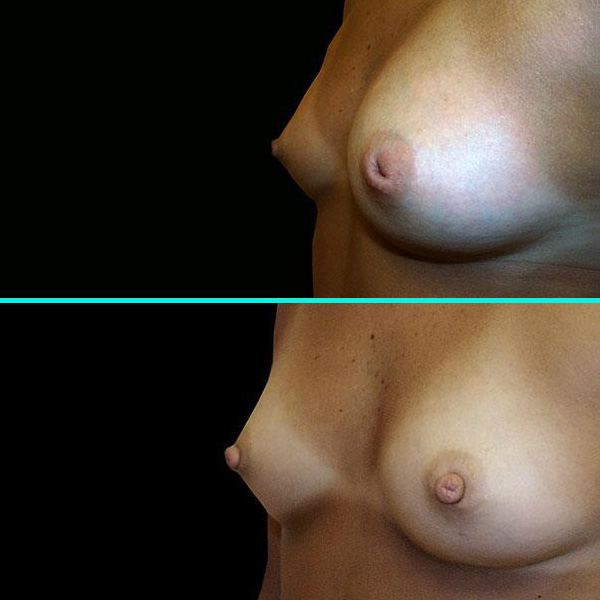 Inverted Nipple Surgery