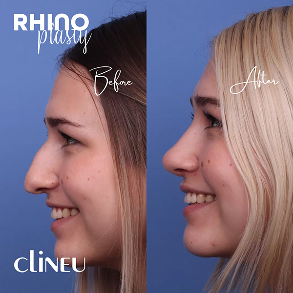 Rhinoplasty