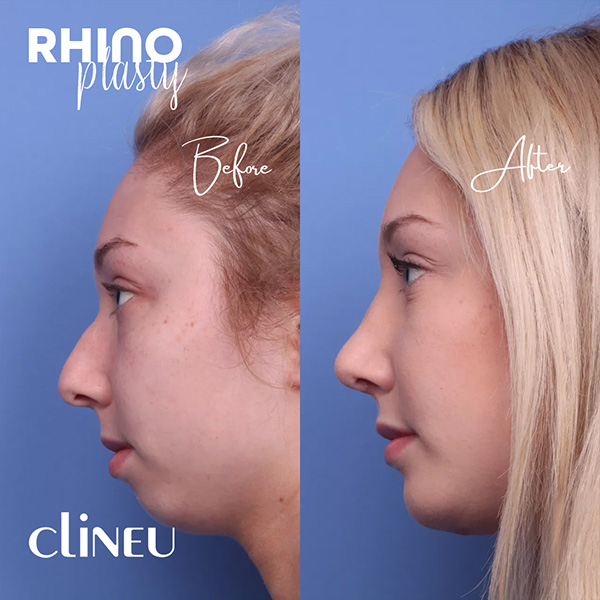 Rhinoplasty