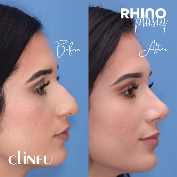 Rhinoplasty