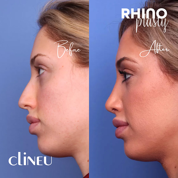 Rhinoplasty