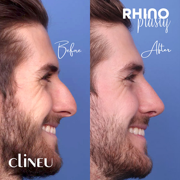 Rhinoplasty