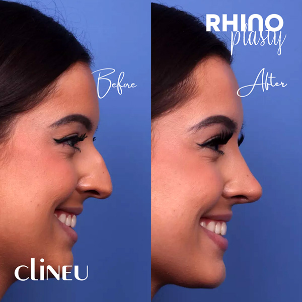 Rhinoplasty