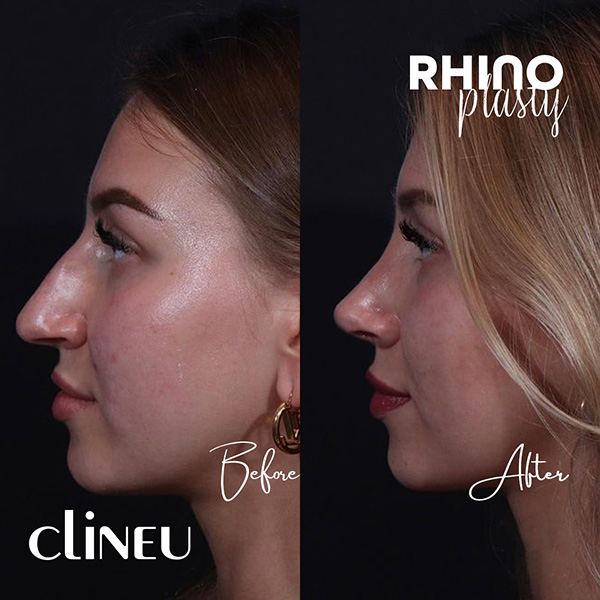 Rhinoplasty