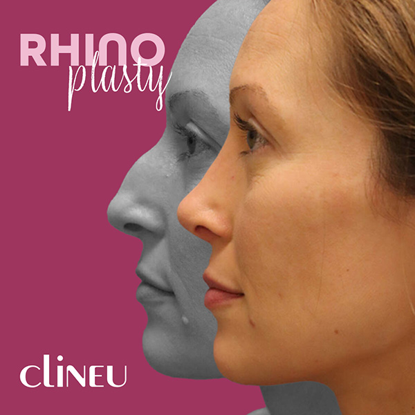 Rhinoplasty