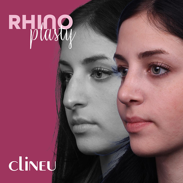 Rhinoplasty