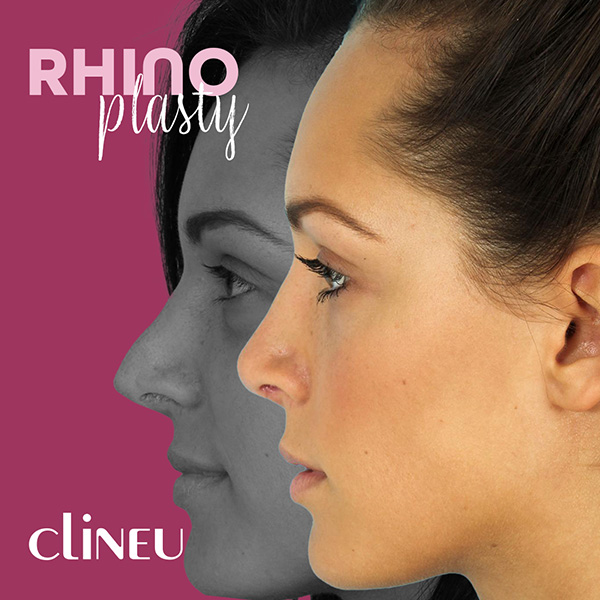 Rhinoplasty