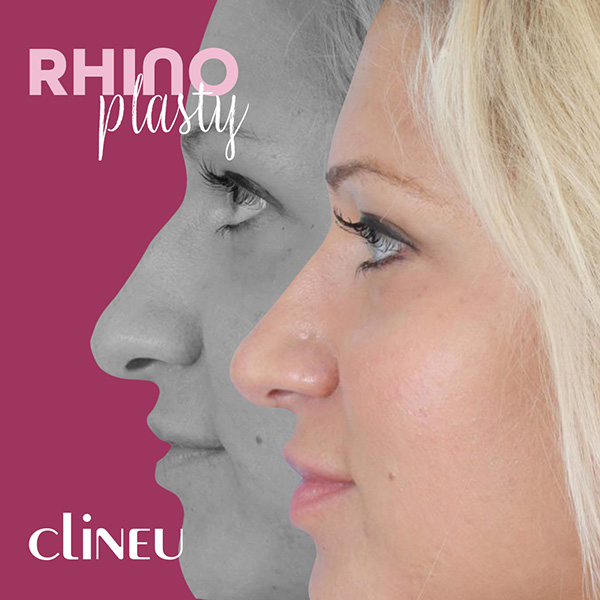 Rhinoplasty