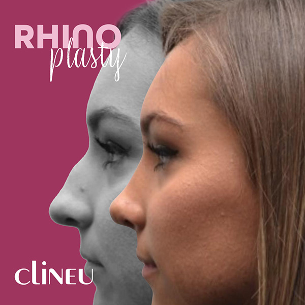 Rhinoplasty