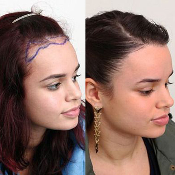 Hair Transplant women