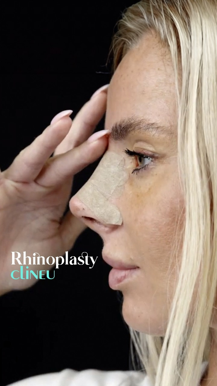 Rhinoplasty