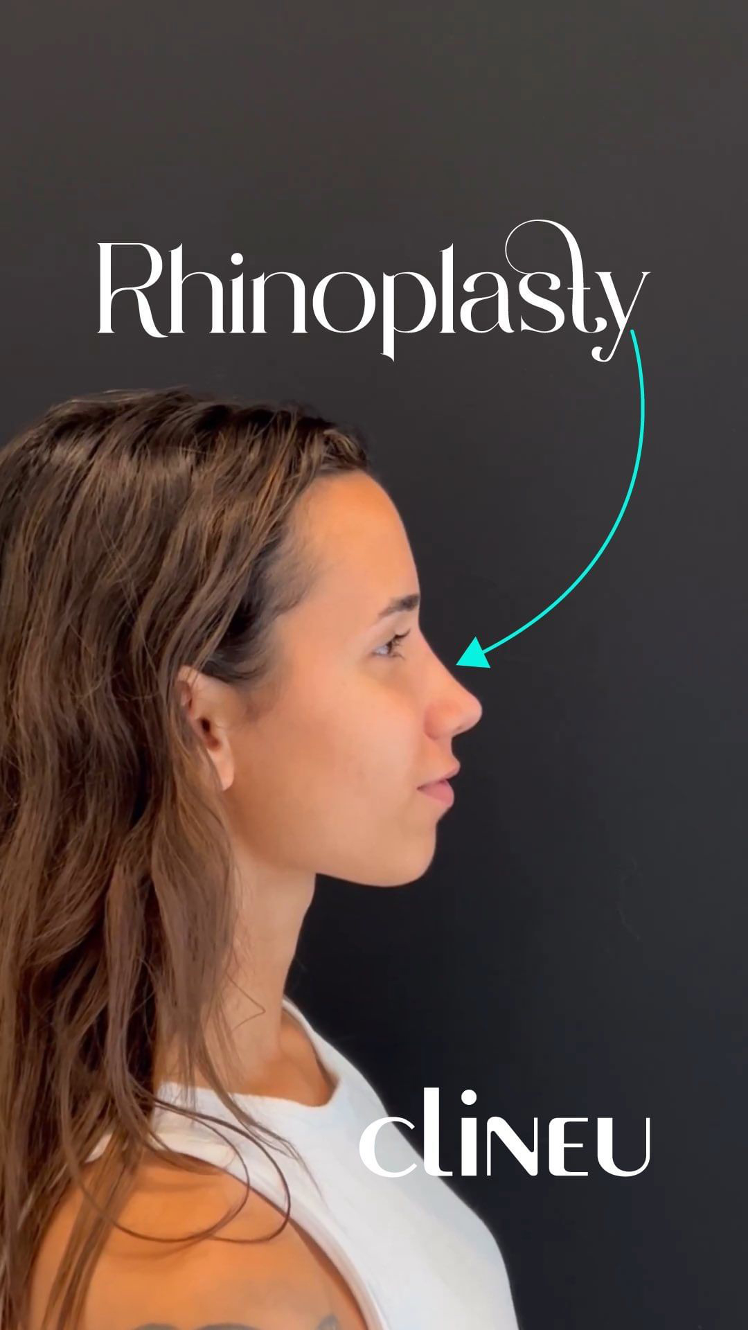 Rhinoplasty